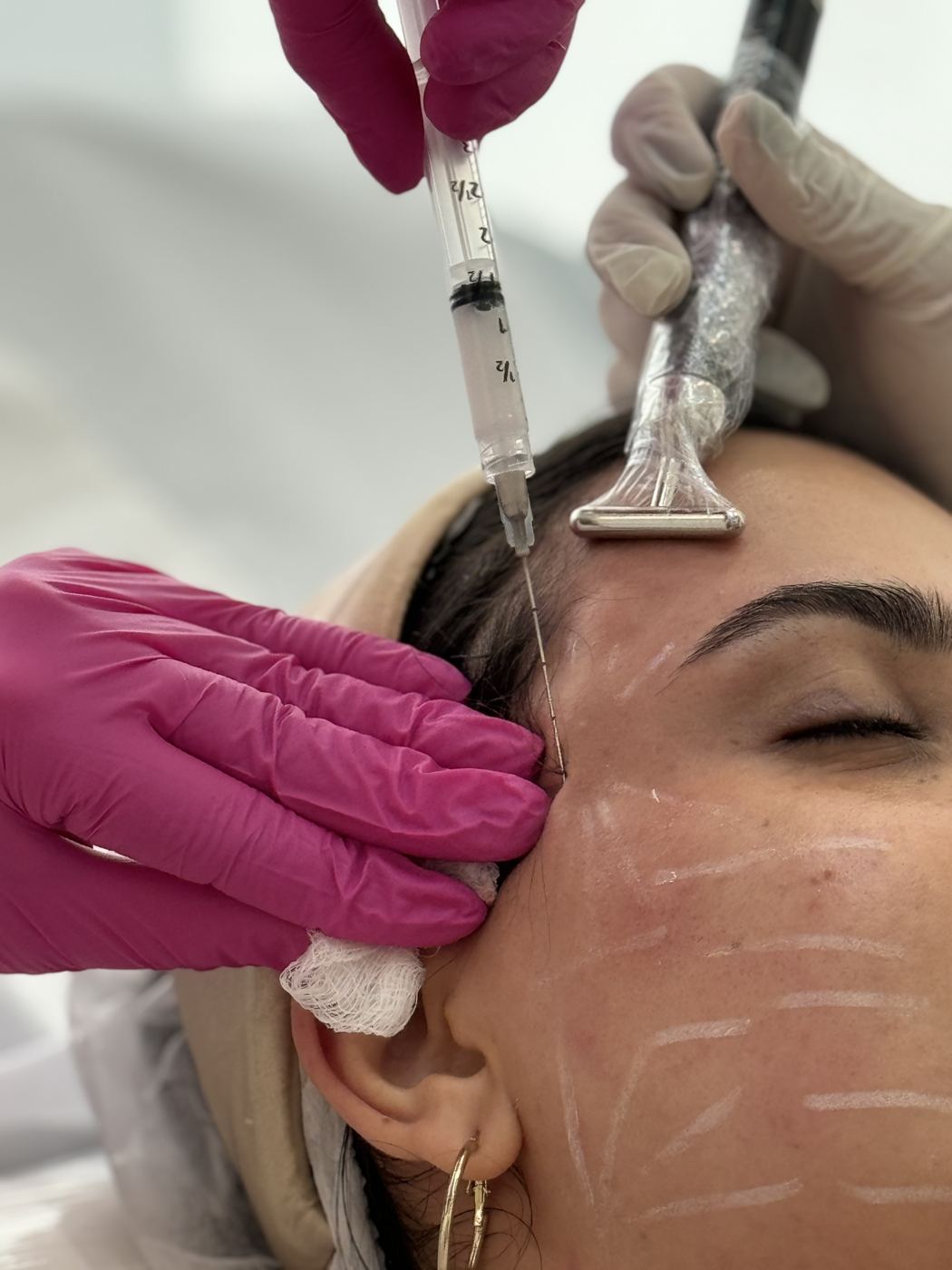 Aplicação de bioestimulador de colágeno facial na Casa Moreira