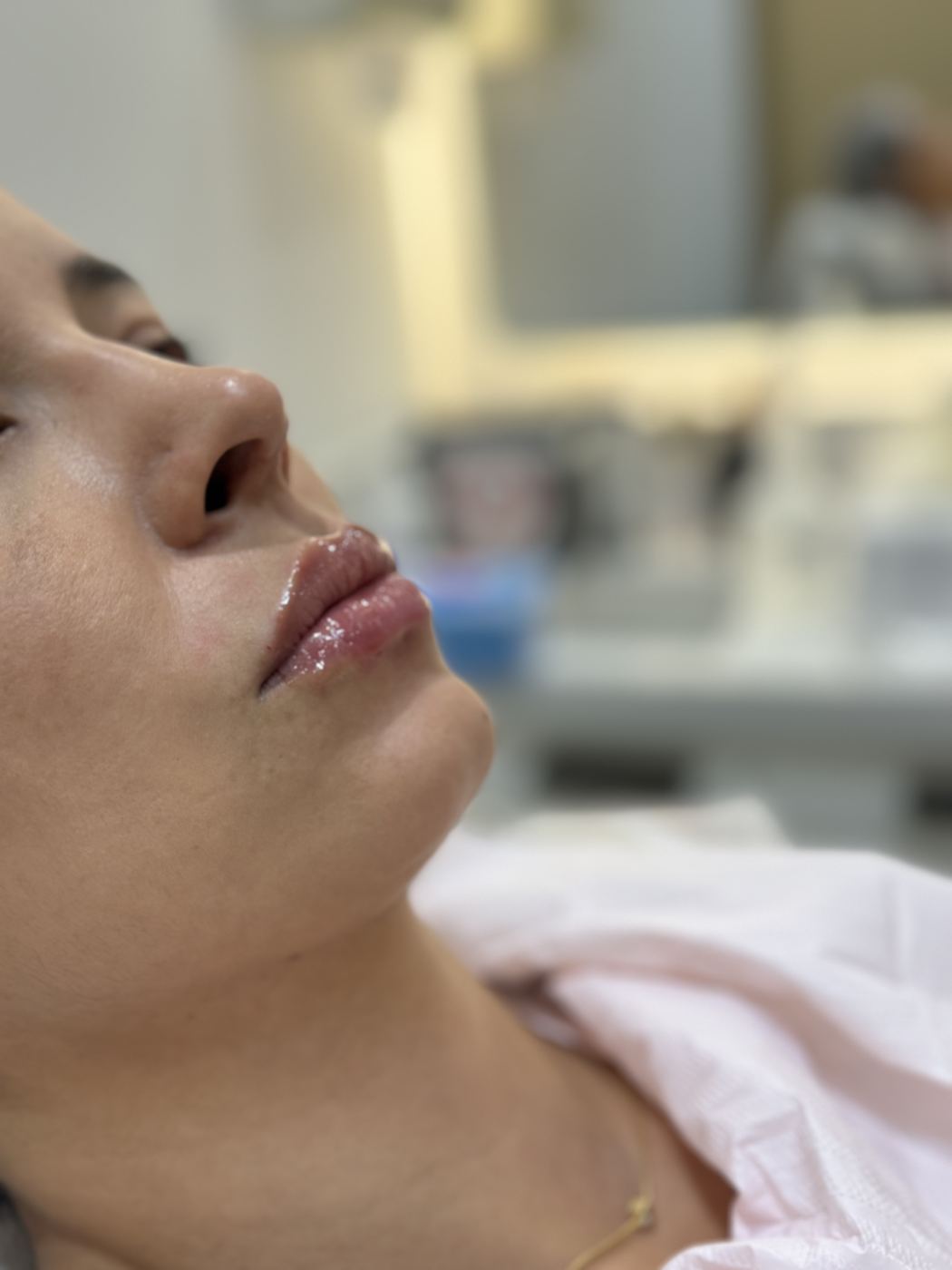 Preenchimento labial com ácido hialurônico realizado na Casa Moreira, em Moema